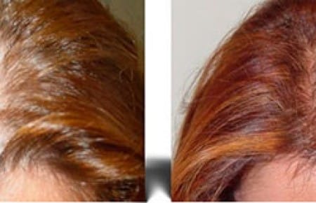 Плазмолифтинг волосистой части головы