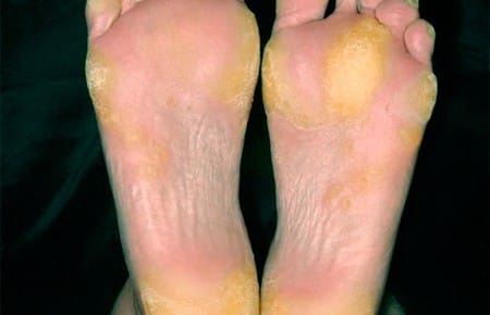 Профилактика и лечение гиперкератоза кожи стопы