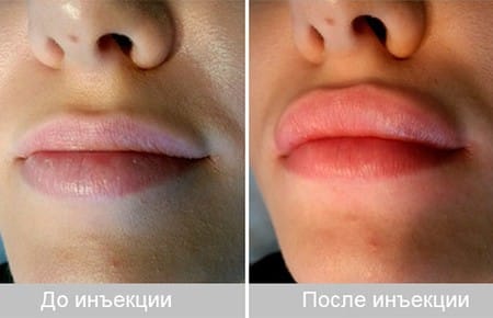 Как увеличить губы при помощи контурной пластики