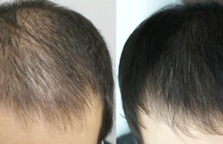 Плазмолифтинг волосистой части головы
