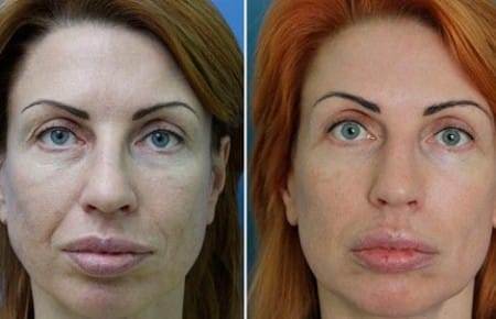Миостимуляция лица. Фото до и после.